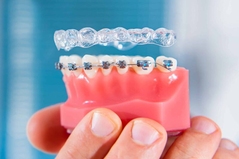 Alternatives for Braces Mobile