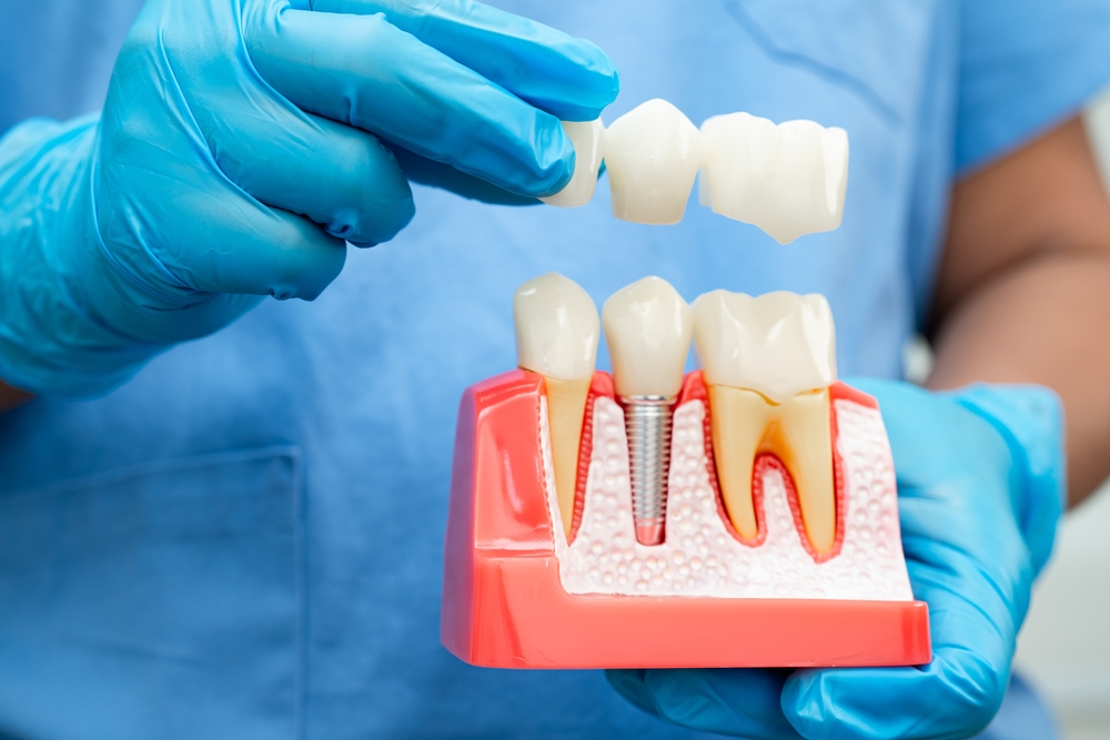 dental implant molar tooth